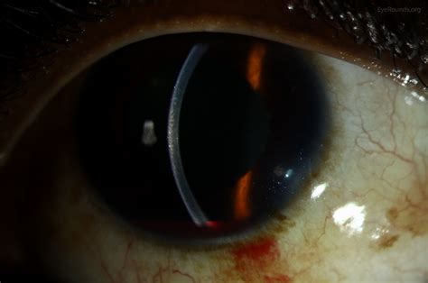 Atlas Entry - Traumatic hyphema