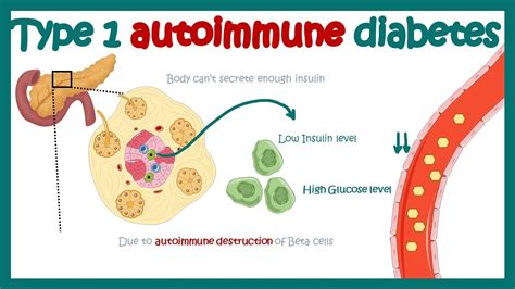 Diabetes Mellitus Type 1