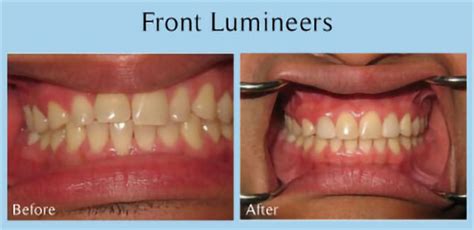 Lumineers and Veneers Before and After Gallery - Gentle Dentistry of San Diego