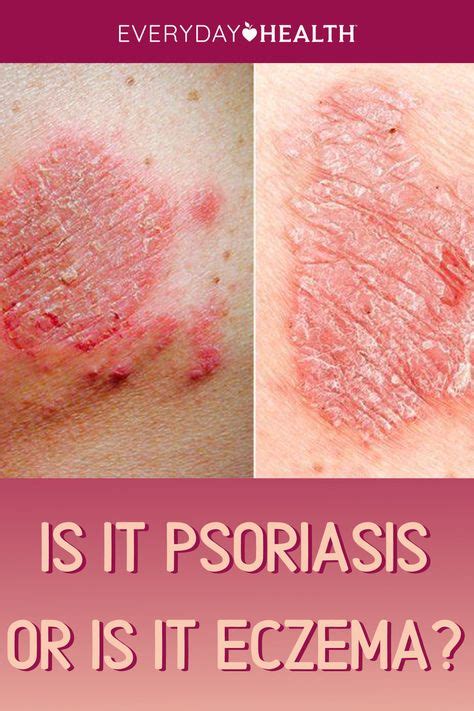 24 Psoriasis / eczema ideas in 2021 | psoriasis, eczema, eczema psoriasis