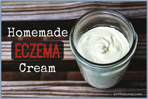 Homemade Eczema Cream: A Natural Solution That Works!