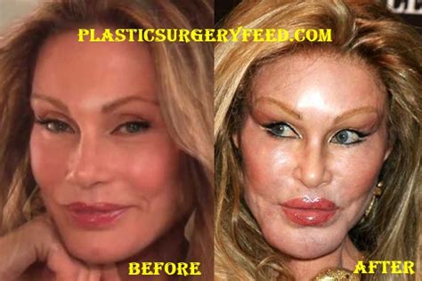 Jocelyn Wildenstein Before Plastic Surgery - Plastic Surgery Feed