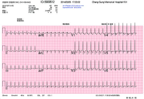 Psvt Ecg Image - Kopler Mambu