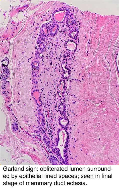 Pathology Outlines - Duct ectasia