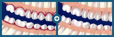 Scaling and Root Planing Memphis TN | Periodontal Associates of Memphis