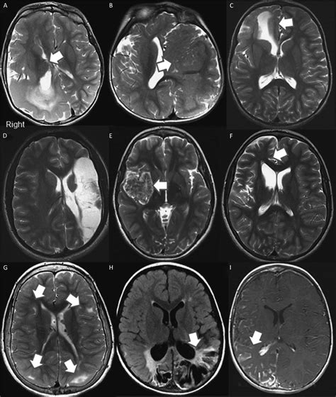 Hemispherectomy | Neurosurgery Blog