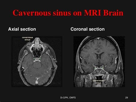 Cavenous sinus thrombosis