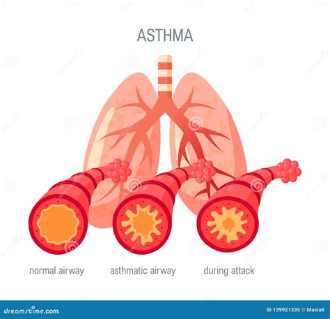 Asthma Disease Vector Icon in Flat Style Stock Vector - Illustration of flat, bronchitis: 139921335