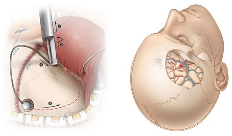 Craniotomy | Expert Surgeon | Aaron Cohen-Gadol MD