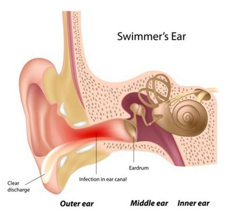 What is Otitis Externa (Swimmers Ear)? (Symptoms, Causes, and Treatment ...