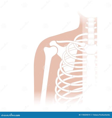 Shoulder Arthroplasty. Shoulder Replacement. Illustration Royalty-Free ...