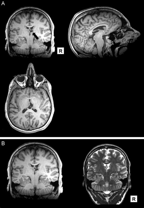 (A) T1 weighted MRI scans of N.C., with arrow pointing to his right... | Download Scientific Diagram