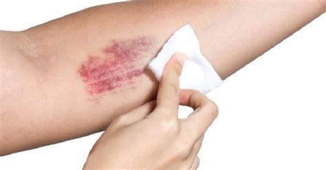 Treatment of and Response to Cuts and Bruises - Arrive Alive