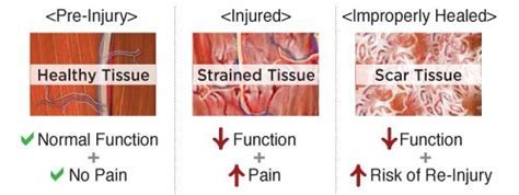 What is the Graston Technique and why do I use it? — Plus Forte Physical Therapy