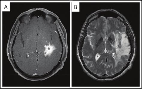 3 Tesla MRI imaging of the brain. A. Axial fat-saturated postcontrast... | Download Scientific ...