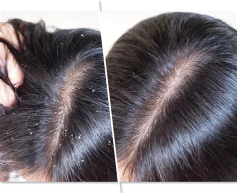 Anti Dandruff & Dry Scalp Treatment in Hyderabad, Chennai