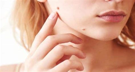 Spotted a mole on your face? Here is everything you need to know about it | TheHealthSite.com