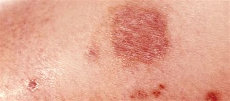 Brown Recluse Spider Bite: Effects & Treatment of Brown Recluse Bite