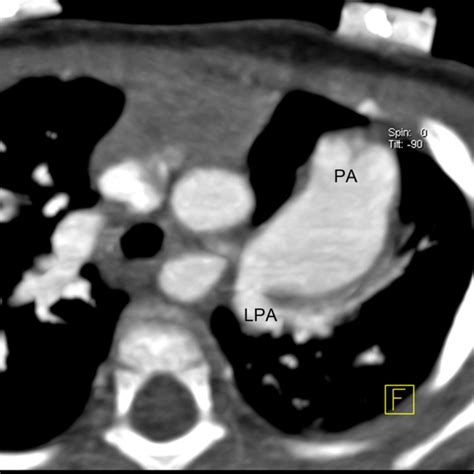 A rare case of crossed pulmonary arteries in an infant - case report | Journal of Cardiothoracic ...