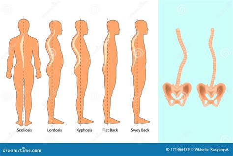 Vector Illustration of Spinal Deformity Types: Scoliosis, Lordosis and Kyphosis. Body Posture ...