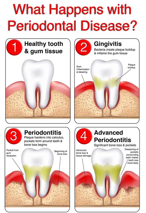 Is Gum Disease Curable? Here's What to Do - Blyss Dental