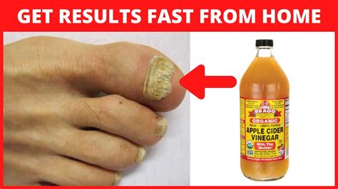 Apple Cider Vinegar for Toenail Fungus - YouTube