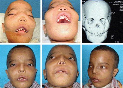 Fibrous dysplasia causes, symptoms, diagnosis, treatment & life expectancy