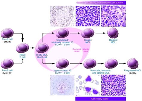 Mantle cell lymphoma symptoms, diagnosis, prognosis and treatment