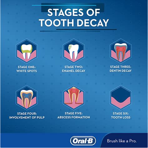 Understanding the Five Stages of Tooth Decay