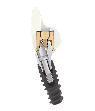 Multi Unit Abutment angled