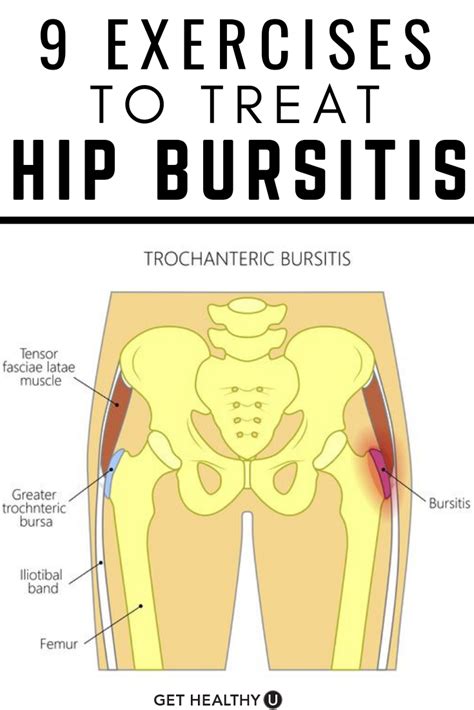 9 best exercises for hip bursitis video included – Artofit