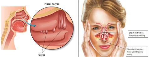 Stuffy nose: Causes, Symptoms and Diagnosis