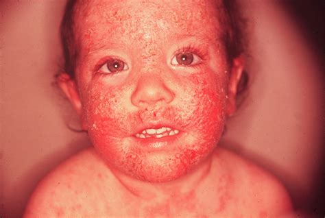 Medical Pictures Info – Atopic Dermatitis