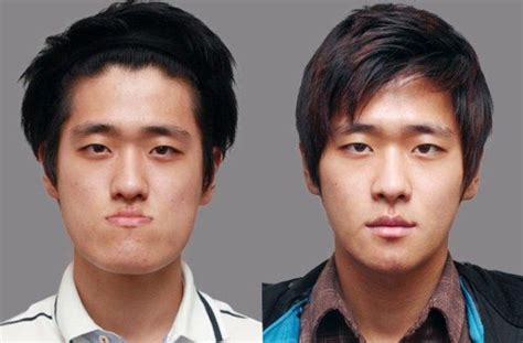 Korean Plastic Surgery Before And After Male