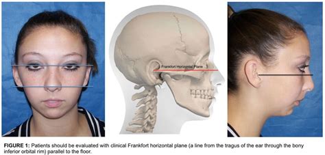 Total TMJ Replacement | Dr. Larry M. Wolford, DMD