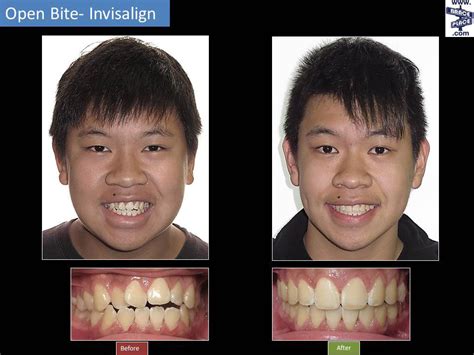 Invisalign Before And After : Invisalign® Before & After - Dentist ...