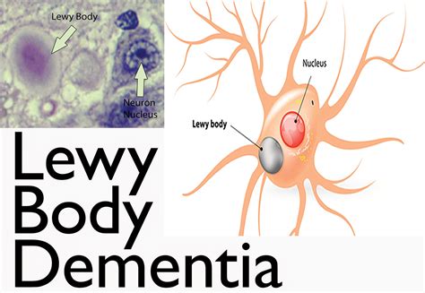 What is Lewy Body Dementia - Causes, Symptoms, Diagnosis, Treatments