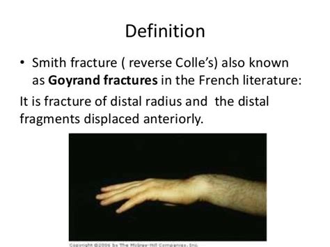 smith fracture, what to know?