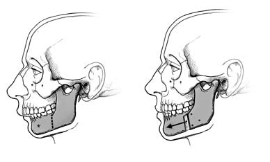 Jaw surgery - Mayo Clinic