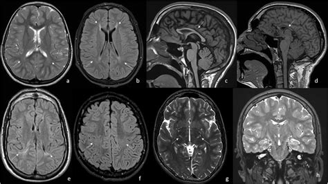 Abnormal Brain Mri Results
