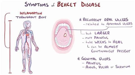 Behcet disease - MEDizzy