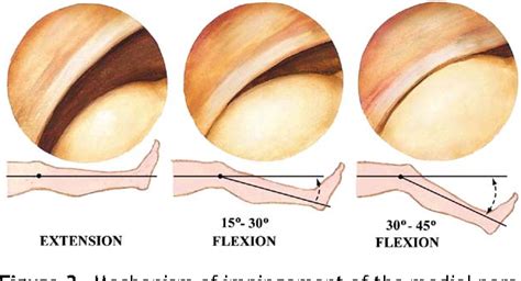 Figure 3 from Synovial plicae of the knee | Semantic Scholar