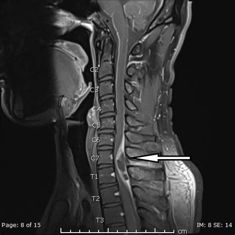 Cureus | A Case of Spinal Epidural Abscess Presenting with Horner Syndrome