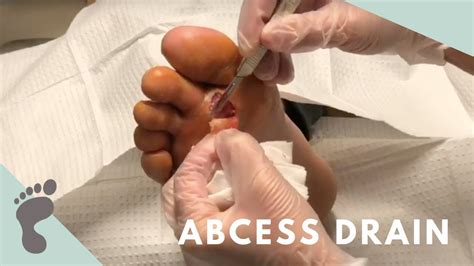 Athlete's Foot Leads to Abscess Drain - YouTube