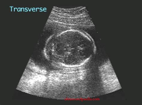 Nuchal thickness – ULTRASOUNDPAEDIA