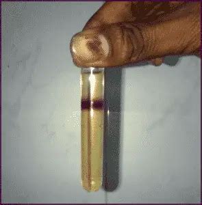 Rothera's Test (Urine ketone bodies test) - Procedure, Principle and ...