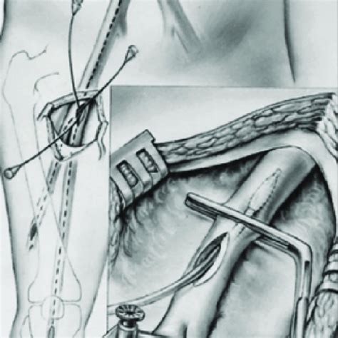 Technique of fogarty catheter embolectomy of the iliofemoral system ...