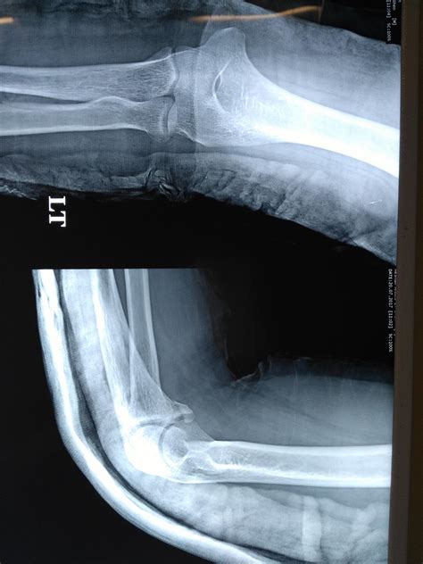 Coronoid Fractures - Trauma - Orthobullets