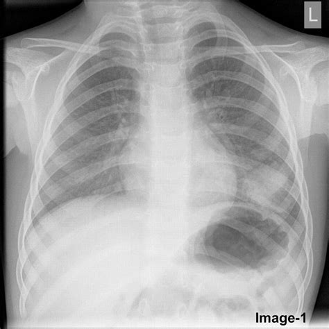 The value of repeat chest radiograph in a child with pneumonia | Archives of Disease in Childhood