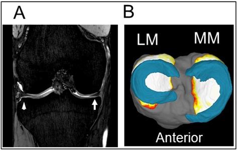 Life | Free Full-Text | Degenerative Meniscus in Knee Osteoarthritis ...